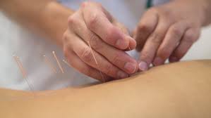 Pijn verminderen met acupunctuur